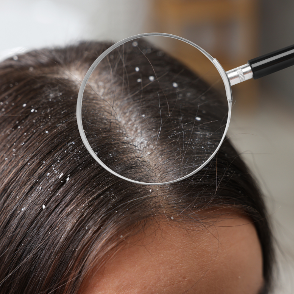 DANDRUFF